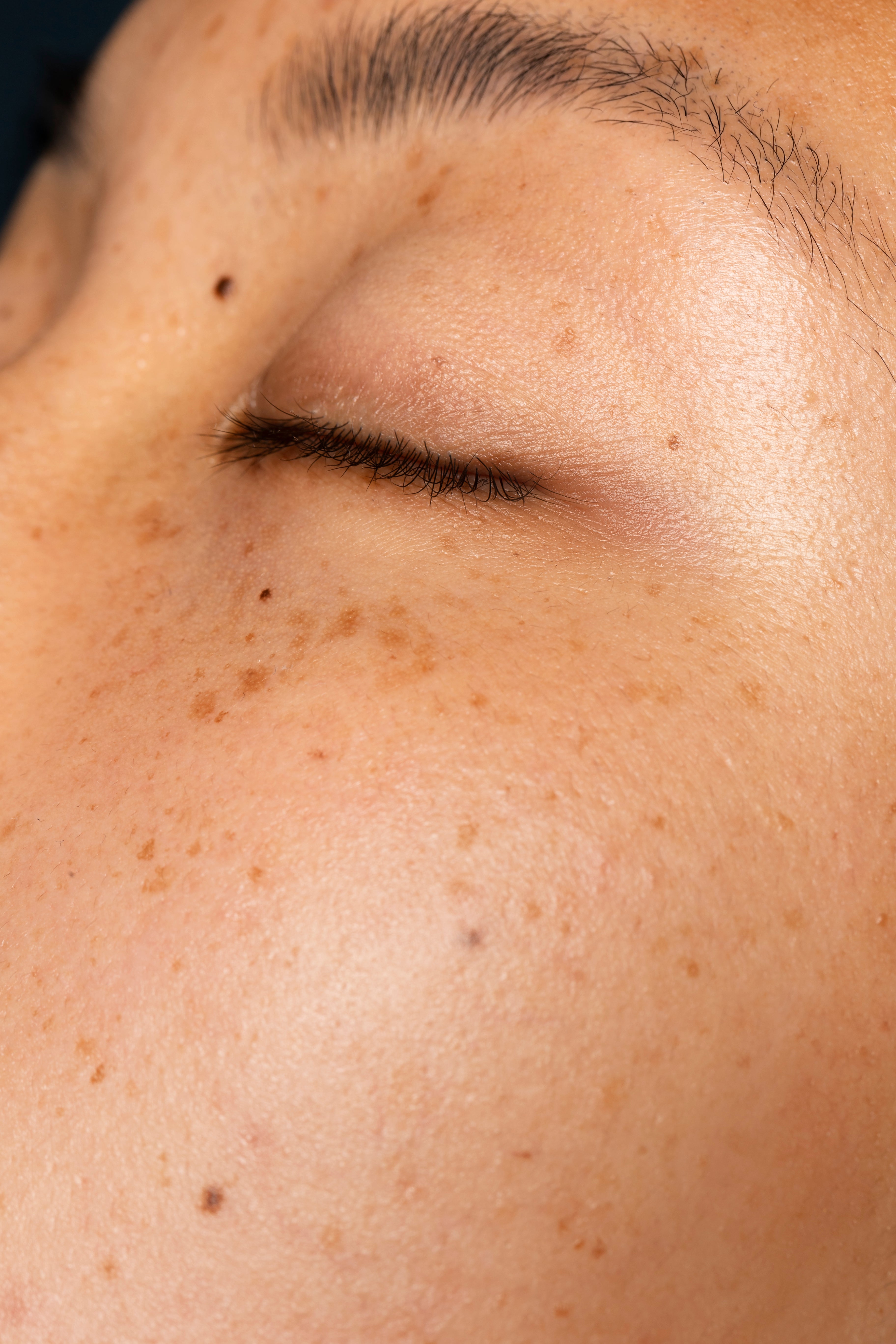 Pigmentation