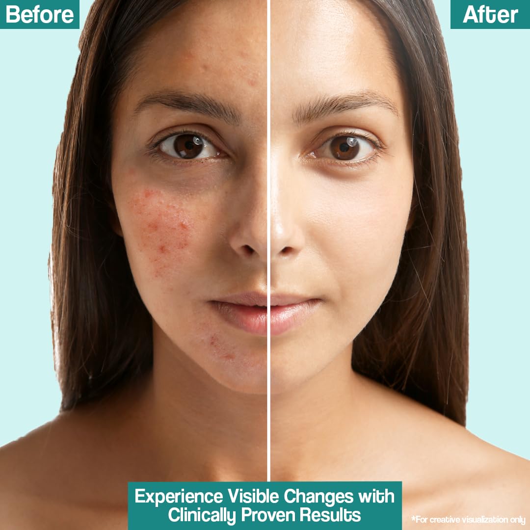 Venusia Acne Control Moisturizer | Pore Minimising & Hydrating | For Oily Skin | Lightens Scars, Reduces Visibility of Pores | Non-comedogenic | 75gm ( Pack of 2 )